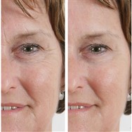 Wrinkle Filler