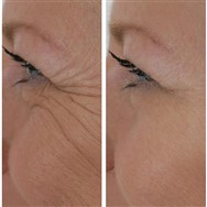 Wrinkle Filler