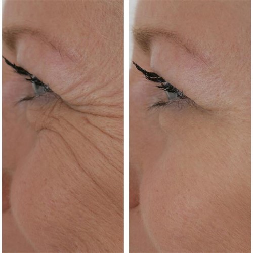 Wrinkle Filler